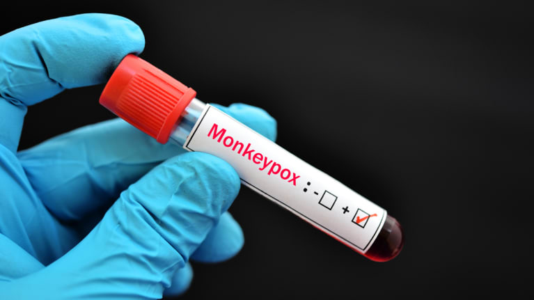 medical test for monkeypox, marked positive