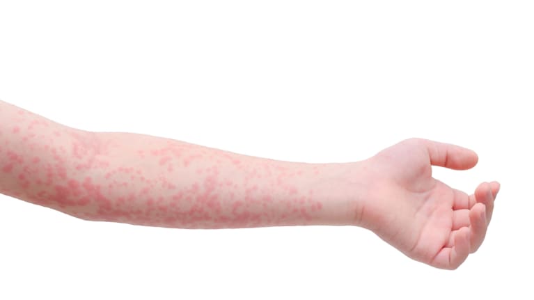 How to Respond to the Spread of Measles in the Workplace 